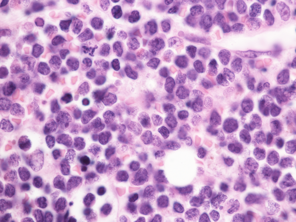 BM core biopsy